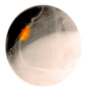 Attack Prints: Angiogram of a blocked coronary artery