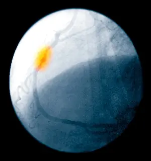 Attack Prints: Angiogram of a blocked coronary artery