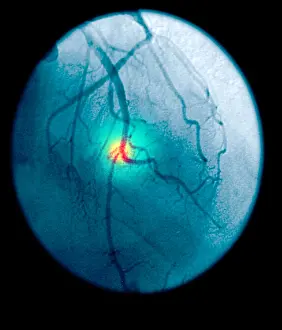 2003 Prints: Angiogram of a blocked coronary artery