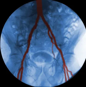 Internal Prints: Angiogram of Iliac Arteries