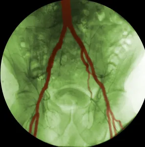 Internal Prints: Angiogram of Iliac Arteries