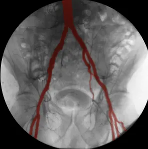 Internal Prints: Angiogram of Iliac Arteries