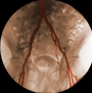 Internal Prints: Angiogram of Iliac Arteries