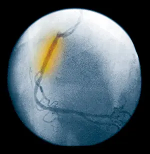2003 Prints: Angiogram of an opened coronary artery