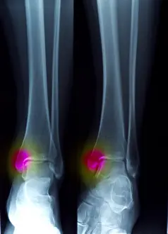 Broken Prints: Ankle Fracture