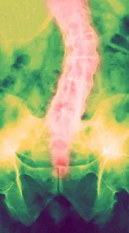 Technique Prints: Ankylosing Spondylitis, X-Ray
