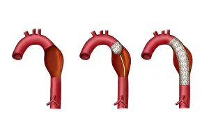 Tubes Prints: Aortic Aneurysm Stent, Illustration