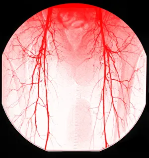 Diagnosis Prints: Aortic Angiogram