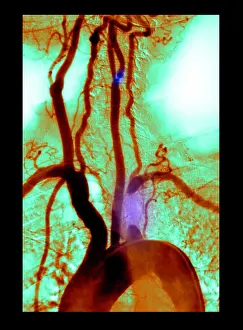 Pathological Prints: Aortic Arch Angiogram, medical scan of the heart