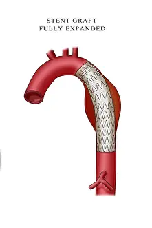 Tubes Prints: Aortic Stent Graft, Illustration