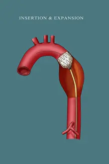 Labeled Prints: Aortic Stent Insertion, Illustration