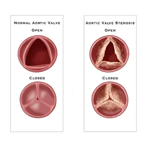Open Prints: Aortic Valve Comparison
