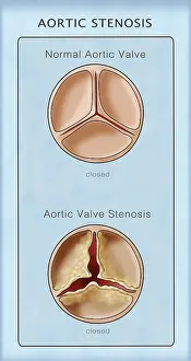 Open Prints: Aortic Valve, Normal & Stenosis, Illustration