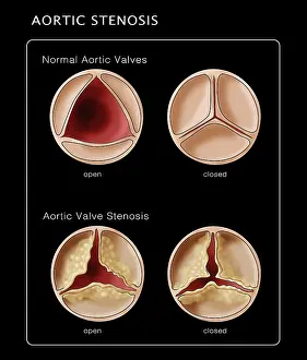 Open Prints: Aortic Valve, Normal & Stenosis, Illustration