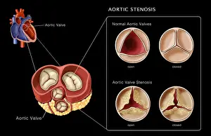Open Prints: Aortic Valves, Normal & Stenosis, Illustration