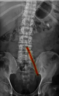Treatment Prints: Aorto-Iliac Bypass Graft