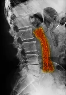 Treatment Prints: Aorto-Iliac Bypass Graft