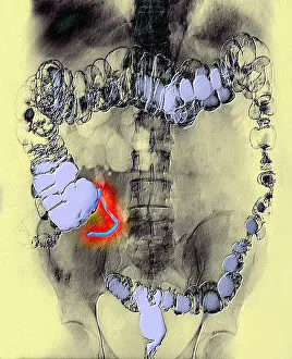 Radiographs Prints: Appendix x-ray with barium contrast