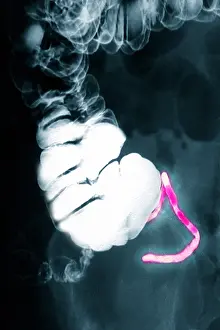 Radiographs Prints: Appendix x-ray with barium contrast
