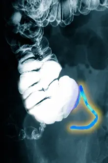 Radiographs Prints: Appendix x-ray with barium contrast