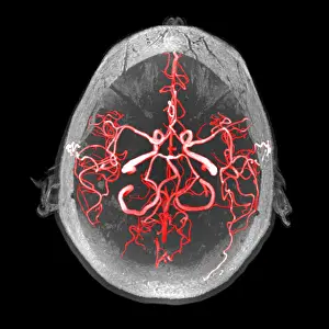Magnetic Prints: Arteries of the Brain, MRA