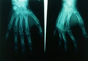 Joint Prints: Arthritic & Normal Hand