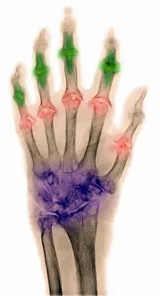 Hand Prints: Arthritis