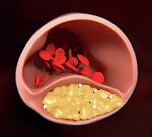 Abnormal Prints: Atherosclerosis, artwork