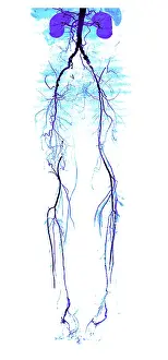Pathological Prints: Atherosclerosis, CT angiogram