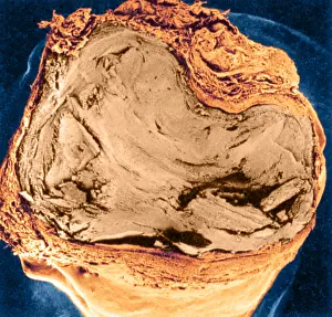 Clots Prints: Atherosclerosis SEM, full blockage