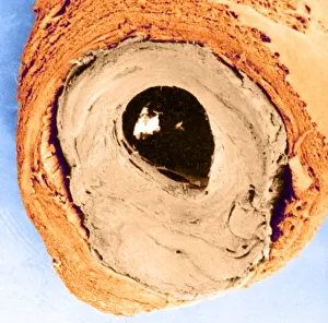 Clots Prints: Atherosclerosis SEM, partial blockage