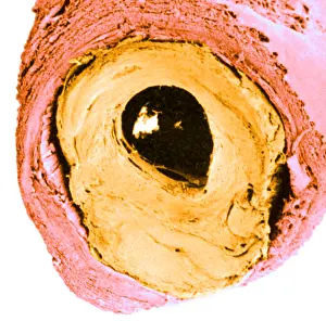 Atherosclerosis SEM, partial blockage