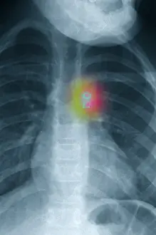 Treatment Prints: Atrial Septal Defect Treatment