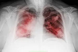 Infection Prints: Atypical Pneumonia in Smoker, X-ray