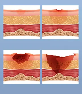 Pressure Prints: Bed Sores
