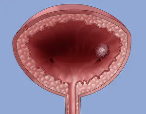 Urinary Prints: Bladder Cancer, Illustration