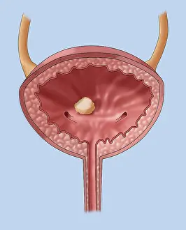 Stone Prints: Bladder Stone, Illustration