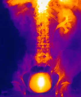 Stone Prints: Blocked, Dilated Uterer (Kidney Stone)