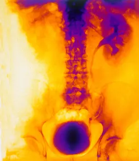 Stone Prints: Blocked, Dilated Uterer (Kidney Stone)