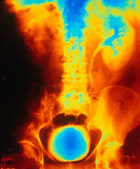 Stone Prints: Blocked, Dilated Uterer (Kidney Stone)