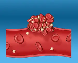 Circulation Prints: Blood clot
