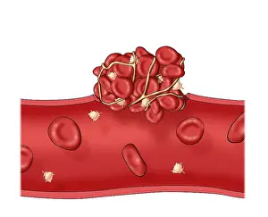 Circulation Prints: Blood clot