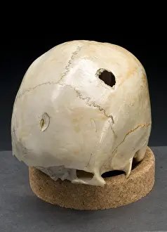 1950 Prints: Blunt Force Hammer Trauma to Skull, 1950's