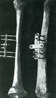 Broken Prints: Bone Clamp