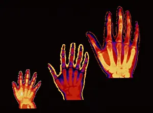 Hand Prints: Bone growth at 2, 6, 19 years