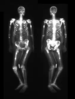 Disorders Prints: Bone scan showing multiple metastases
