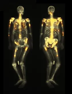 Disorders Prints: Bone scan showing multiple metastases