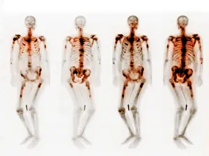 Disorders Prints: Bone scan showing multiple metastases