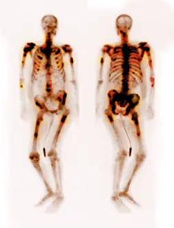 Disorders Prints: Bone scan showing multiple metastases