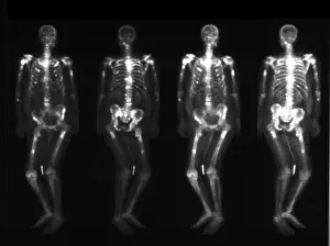 Disorders Prints: Bone scan showing multiple metastases